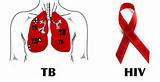 DINAS KESEHATAN CURIGAI ADANYA KETERIKATAN ANTARA PENYAKIT TBC DENGAN HIV AIDS