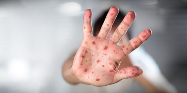 DIAWAL TAHUN 2017 KASUS CAMPAK DI KABUPATEN BLITAR MENINGKAT DRASTIS